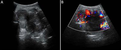 Parapharyngeal meningioma extending through foramen ovale: a case report